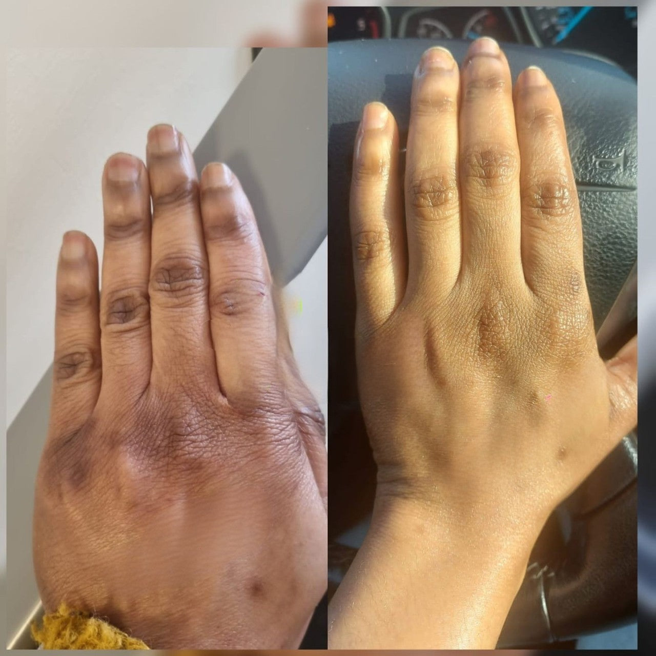 Treating Dark Knuckles with Niacinamide (Vitamin B3): A Proven Solutio – GlutaMaster